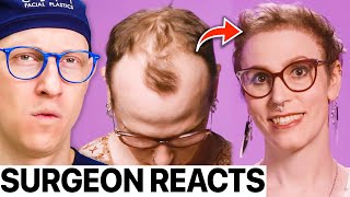 Il trapianto di capelli che ha cambiato la vita di una paziente dopo la transizione | La reazione...