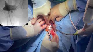 V03-03: Adjustable Continence Therapy for Stress Urinary Incontinence: A Minimally Invasive Solution