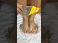 Cracked Heels Gone in 5 Minutes #foothealth #diy