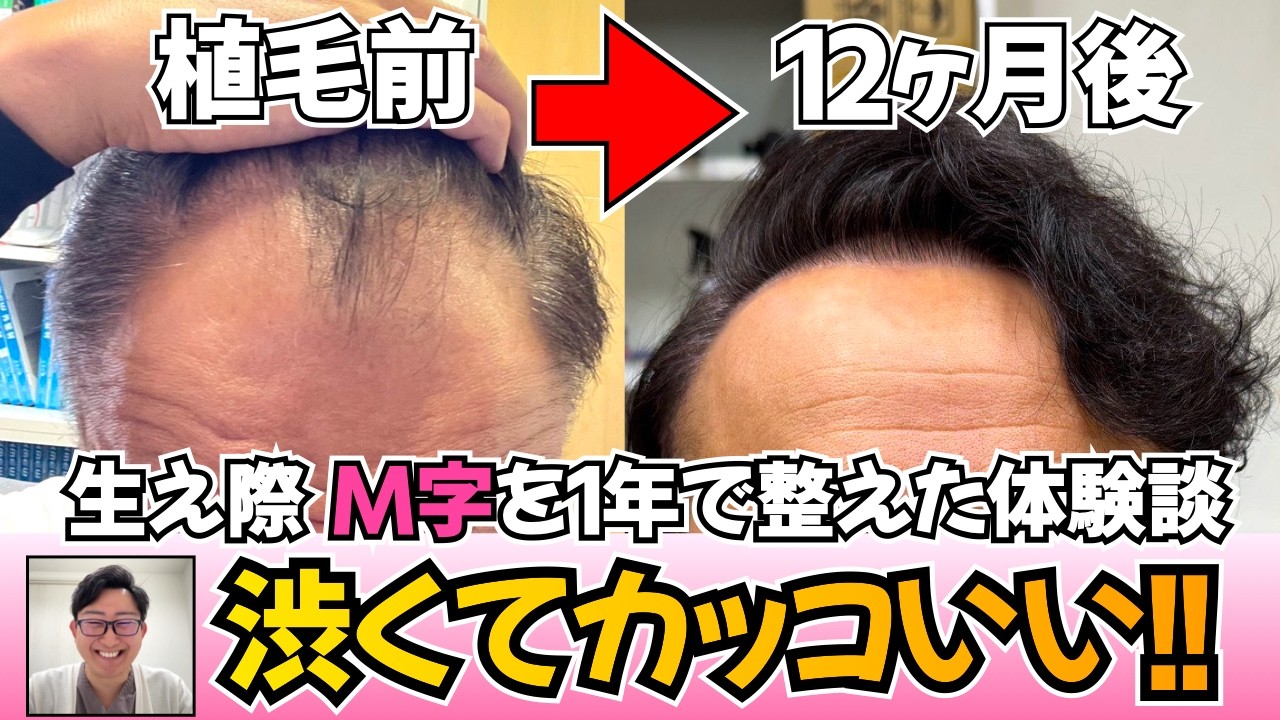 【おでこ生え際】人前に出るの恥ずかしかったがM字を植毛して解決!! 【薄毛対策｜自毛植毛】