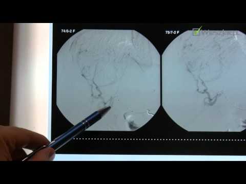 Gdzie najczęściej lokalizują się przerzuty raka wątroby?