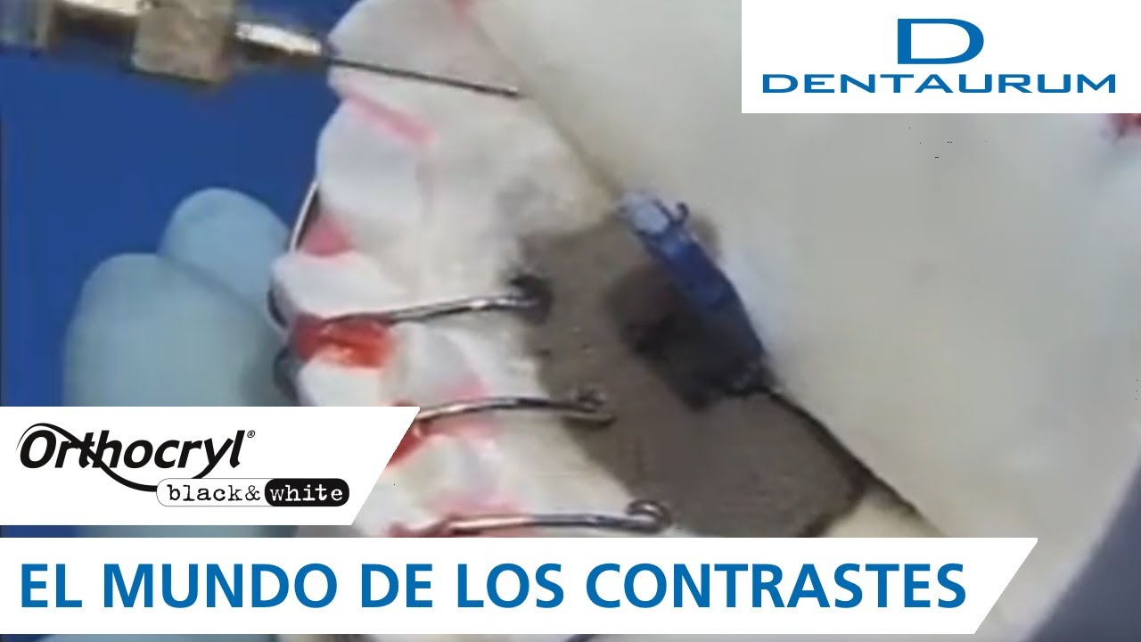 Técnica de rociado: el mundo de los contrastes con Orthocryl® black & white (aparatos dentales)