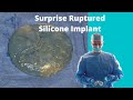 Silicone Breast Implant Rupture Discovered During Breast Augmentation Surgery