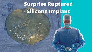 Download lagu Silicone Breast Implant Rupture Discovered During Breast Augmentation Surgery mp3