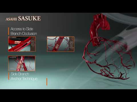 ASAHI SASUKE Double Lumen Catheter Introduction Video