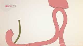 Stomach resection • Billroth II • Oncolex
