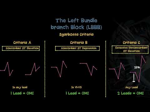 Understanding Sgarbossa Criteria - Good Reads