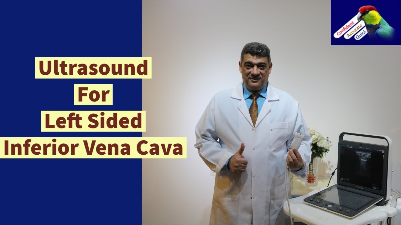 Left Sided Inferior Vena Cava