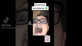 removing tonsil stone subscribe