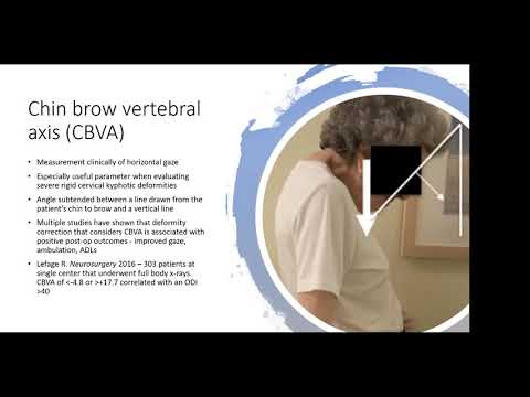 Cervical Alignment and Deformity presented by Daniel Reid, MD, on November 23, 2020
