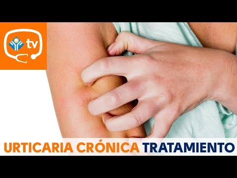 I'm dying of itching. Is there any effective treatment for chronic hives?