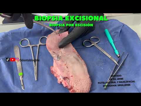 Biopsia excisional