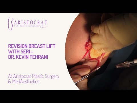 Revision Breast Lift with Seri - Dr. Kevin Tehrani
