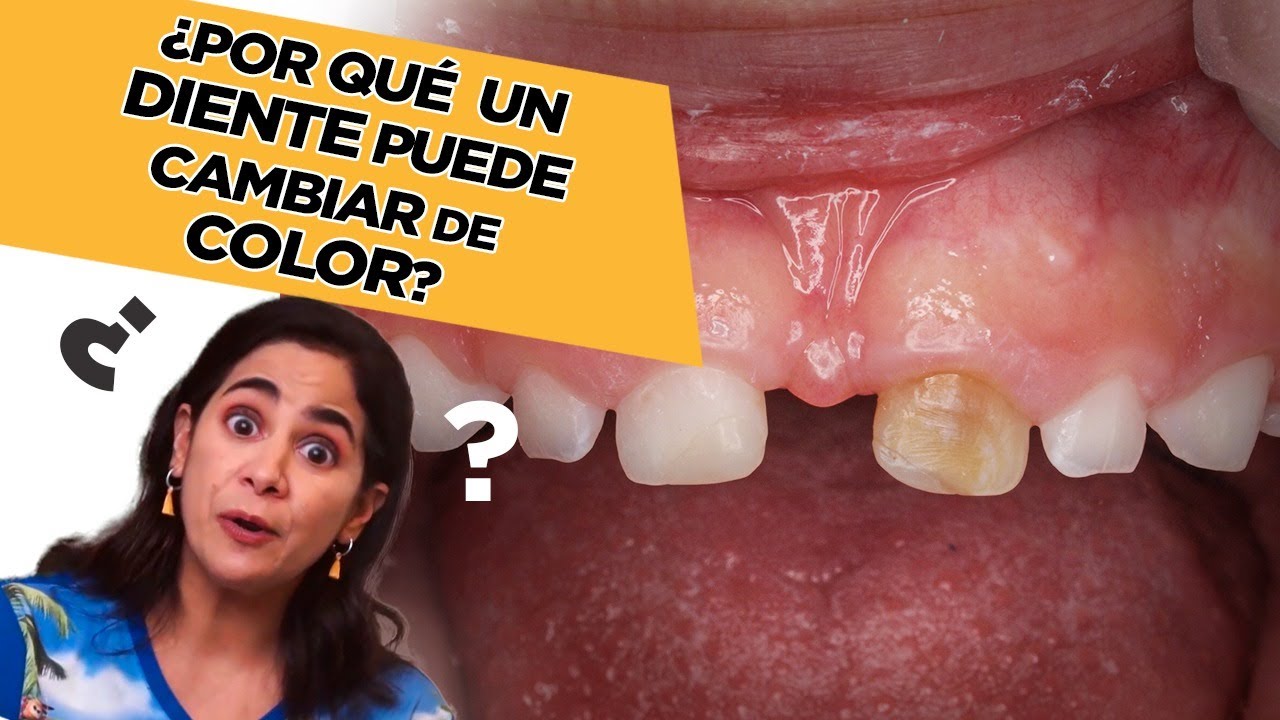 Watch Cambio de color del diente: ¿Por qué Now Cambio de color del diente: ¿Por qué