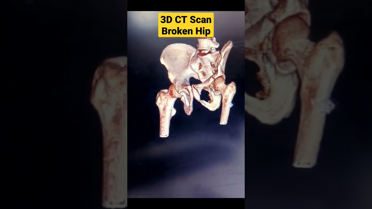 3D CT Scan Broken Hip | #hipfracture #ctscan #mriscan #hippain #hipbone #healthtips #hiparthritis |