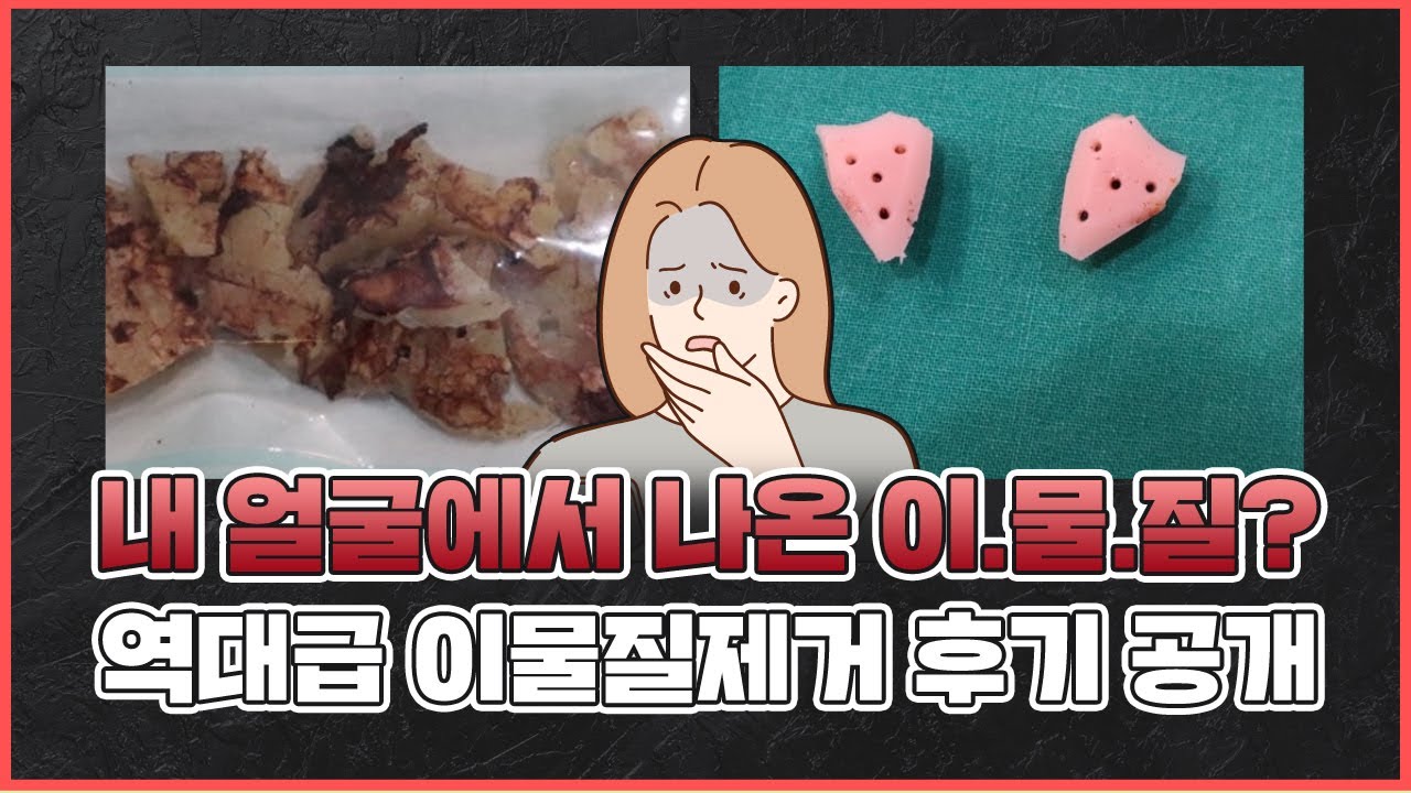 얼굴 #지방이식 #실리콘 #필러 함부로 하면 안되는 이유! | #이물질제거 전후사진 공개 | #안면거상술 잘…