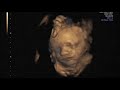 Ultrasound Week 30 Video
