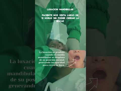Luxación mandibular Barranquilla - Dr. José Fragozo cirujano maxilofacial