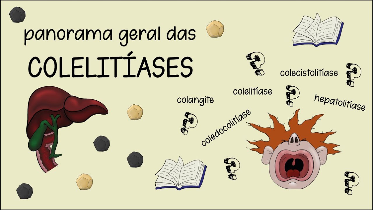 Introdução a Colelitíase (coledocolitíase, colangite, colecistites, síndrome de Mirizzi)