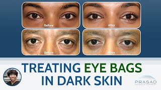 Treating Eye Bags in Dark Skin