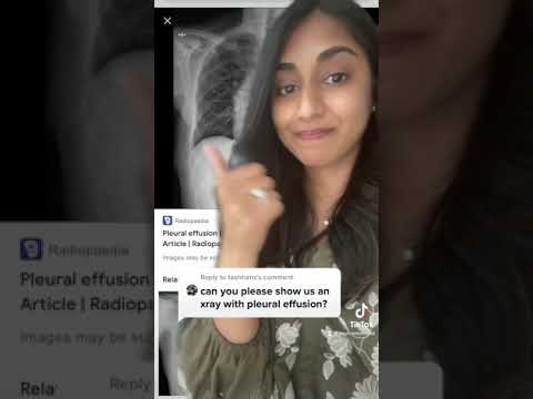 Pleural effusions! #medicine (image sources as shown!) #shorts