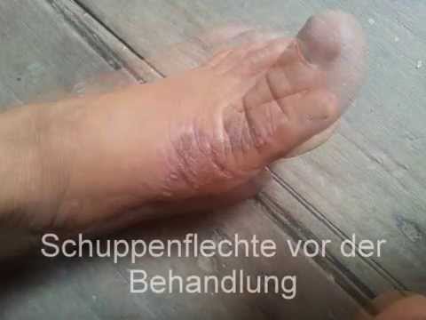 Die Schuppenflechte die Behandlung in kirowograde Die die Schuppenflechte provozierenden Lebensmittel