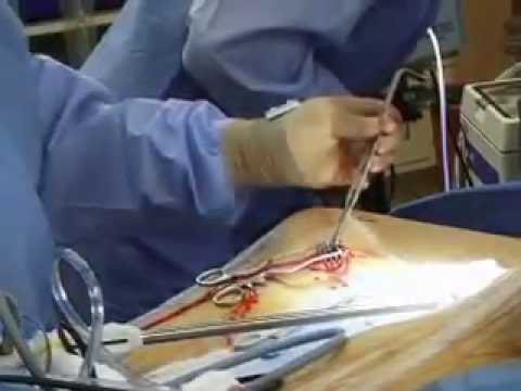 Coronary Bypass Surgery - MedStar Union Memorial