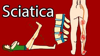 Sciatica - One-sided Leg pain and tingling.  Sciatica Symptoms and Treatment. Radiculopathy
