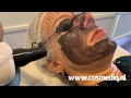 Cosmediq: Carbon Laser Peeling