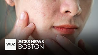 Popular weight loss drugs may trigger acne in women, researchers say