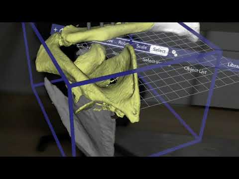Floating Shoulder - Clavicle and Scapula Fracture with Mixed Reality