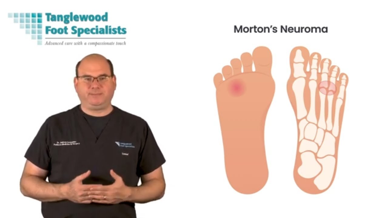 Mortons Neuroma Explained