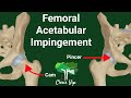 Femoral Acetabular impingement (FAI) Explained (Animated)