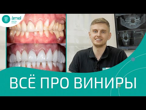 Вопросы о винирах: Портятся зубы? Сколько прослужат? Есть противопоказания? | Amel Dental Clinic