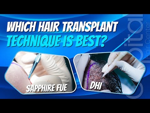 Sapphire FUE vs. DHI Hair Transplant Methods | Capital Hair Center #sapphire #dhi #hairtransplant