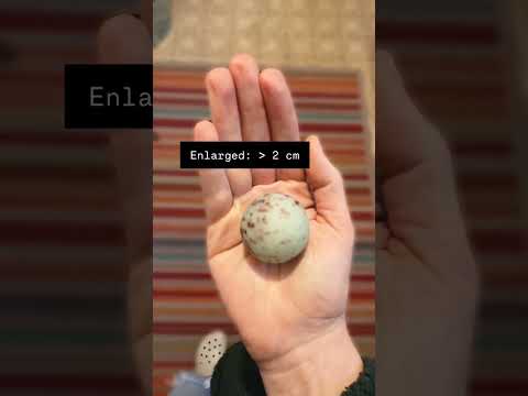 What’s normal and what’s not? #lymph #lymphnodes #lymphlove