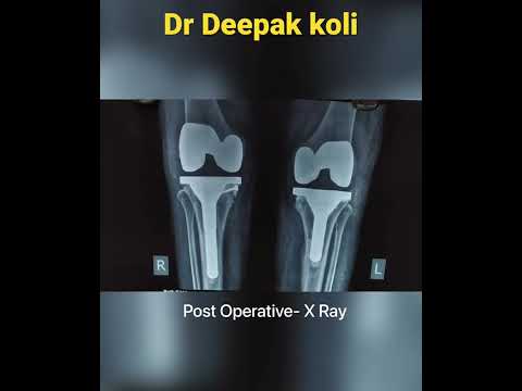 Orthopaedic Surgery- Knee Deformity correction| Dr. Deepak Koli
