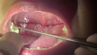 How to remove Tonsil Stones || Immediate Relief after TONSIL STONE Removal