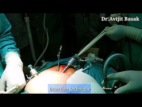 Handmade Endobag and Insertion Technique by Dr.Avijit Basak