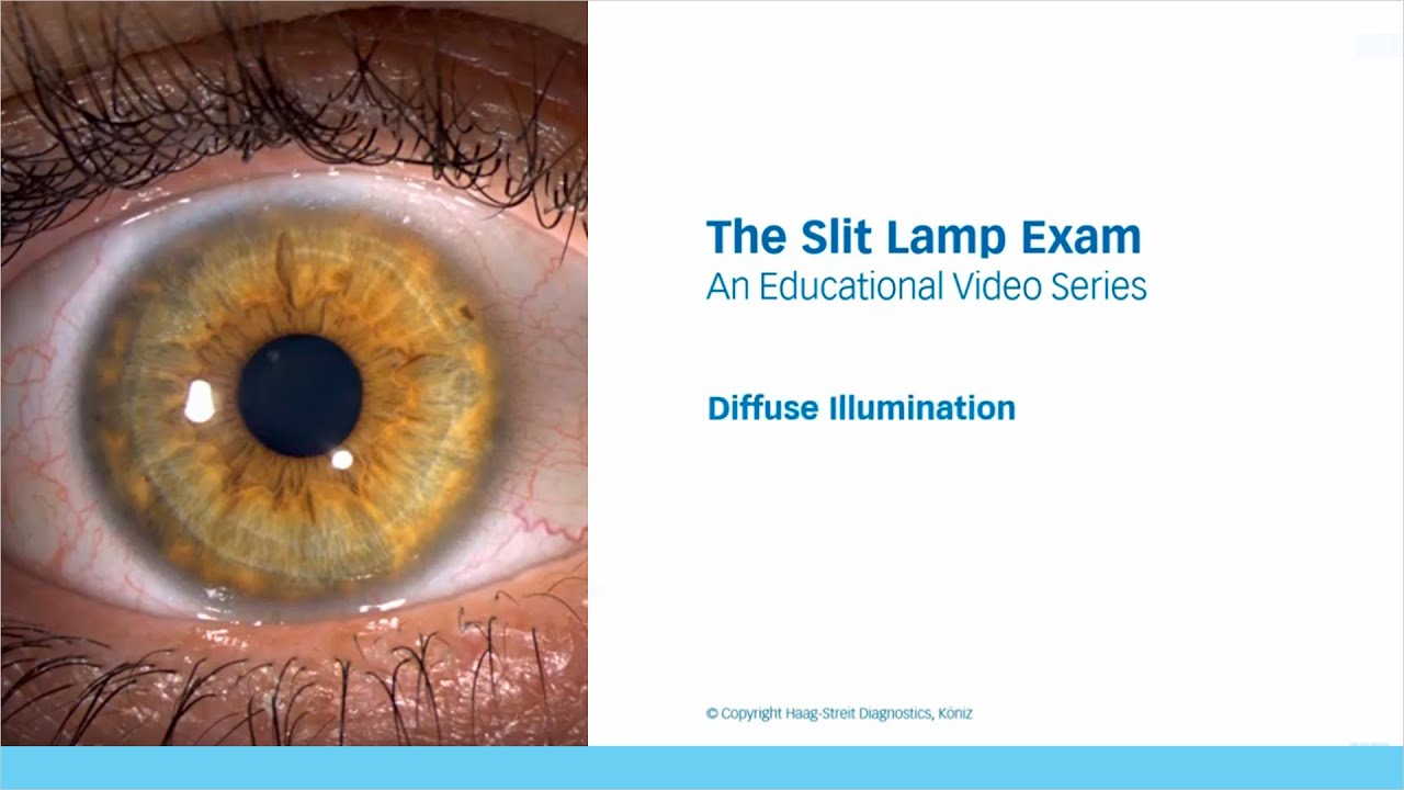 The Slit Lamp Exam – Episode 6, Diffuse Illumination