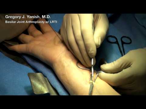 Thumb Basilar Joint Arthroplasty with LRTI