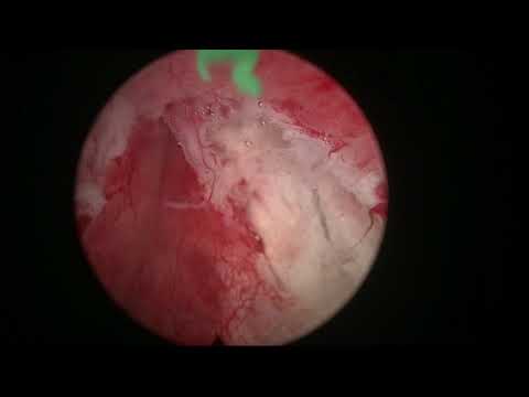 Real-life HoLEP Case Number 7: Refractory Retention-ExcellentExplanation Of Early Apical Dissection