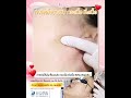 รีวิวหัตถการโปรแกรม CO2 Laser จี้กระเนื้อ
