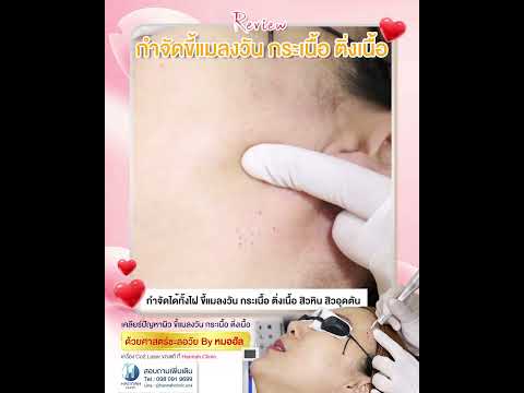รีวิวหัตถการโปรแกรม CO2 Laser จี้กระเนื้อ