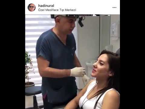 Rhinoplasty 10th day Results