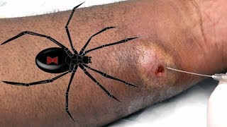 Black Widow Spiders & Dr Gilmore's Spider Bites