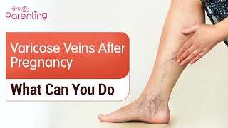 Varicose Veins After Pregnancy : How to Mange It