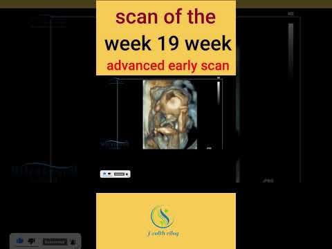 scan of the week 19 week advanced early scan #pregnancy #baby #pregnant #babies #ultrasound