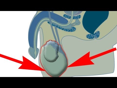Prostatitis Behandlung in der Volksmedizin Weibliches Prostata Video