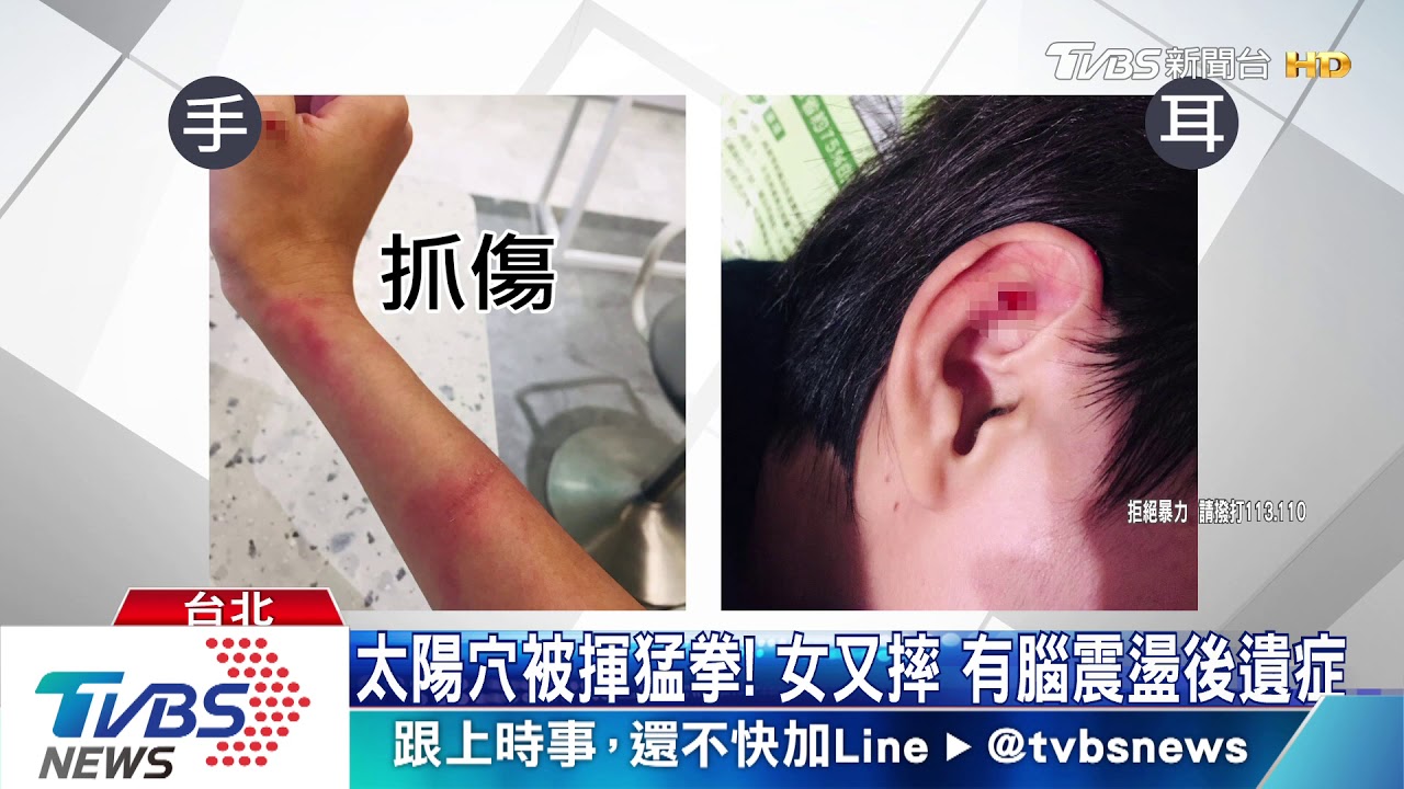 手足情滅!與父談房貸款 女控遭兄弟打傷